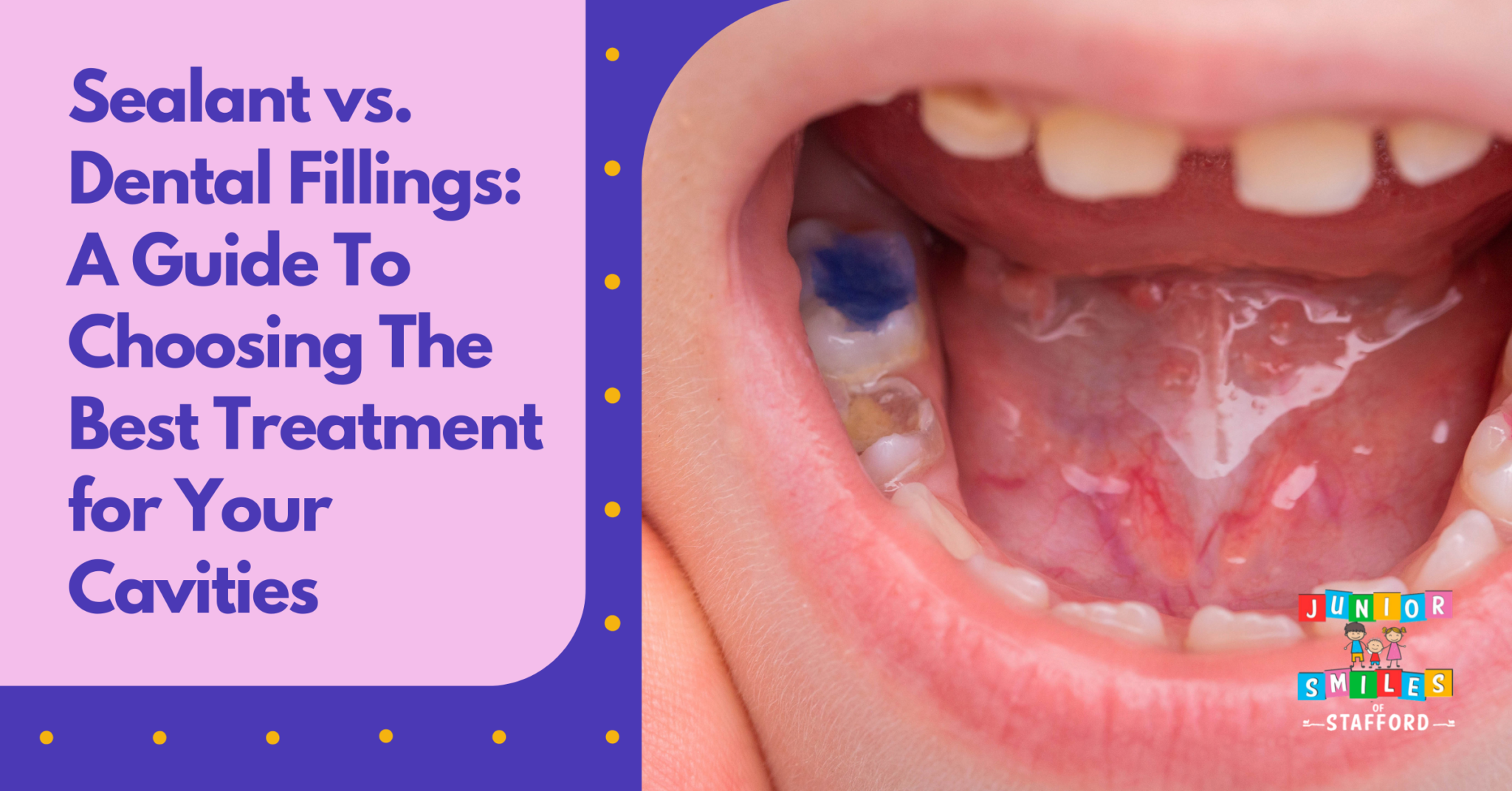 Sealant vs. Dental Fillings A Guide to Choosing the Best Treatment for