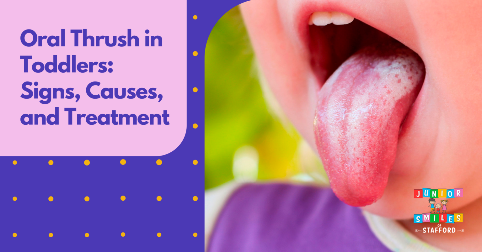 Oral Thrush in Toddlers: Signs, Causes, and Treatment | Junior Smiles ...